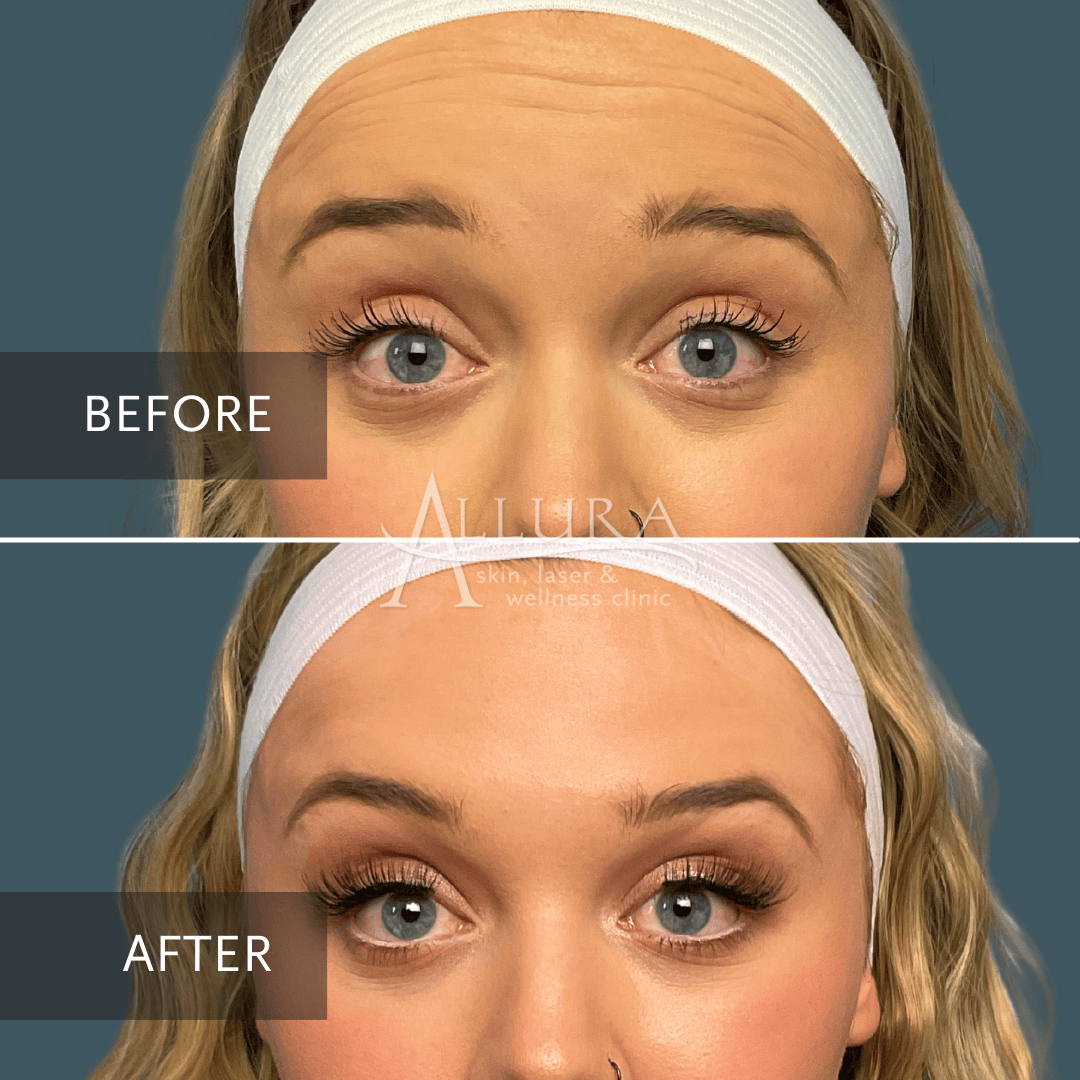 BOTOX® Cosmetic Allura Skin, Laser & Wellness Clinic Fort Collins & Loveland CO