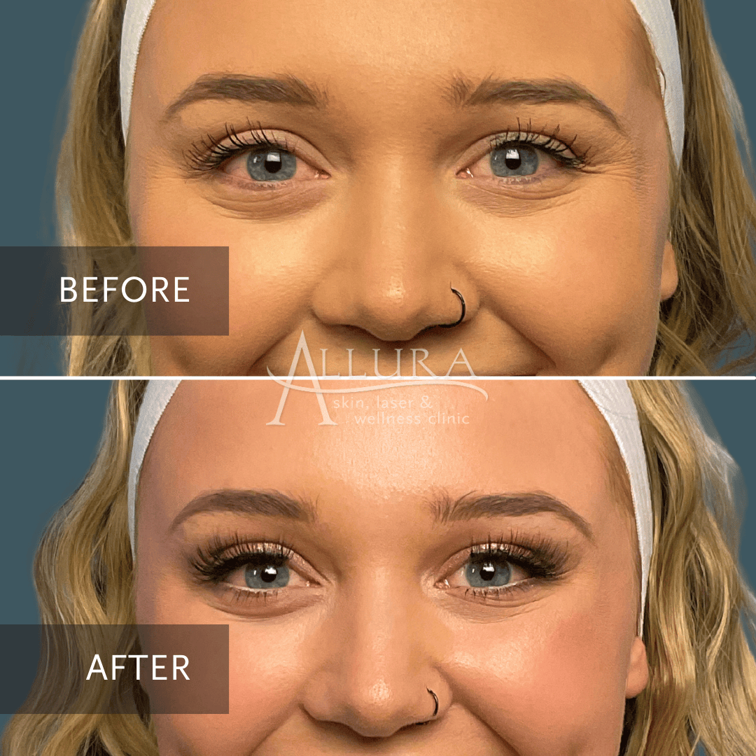 BOTOX® Cosmetic Allura Skin, Laser & Wellness Clinic Fort Collins & Loveland CO