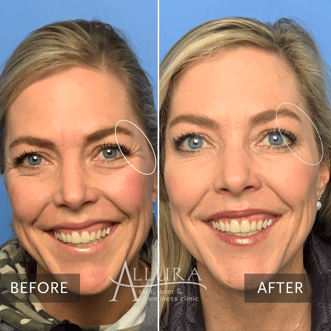 BOTOX® Cosmetic Allura Skin, Laser & Wellness Clinic Fort Collins & Loveland CO