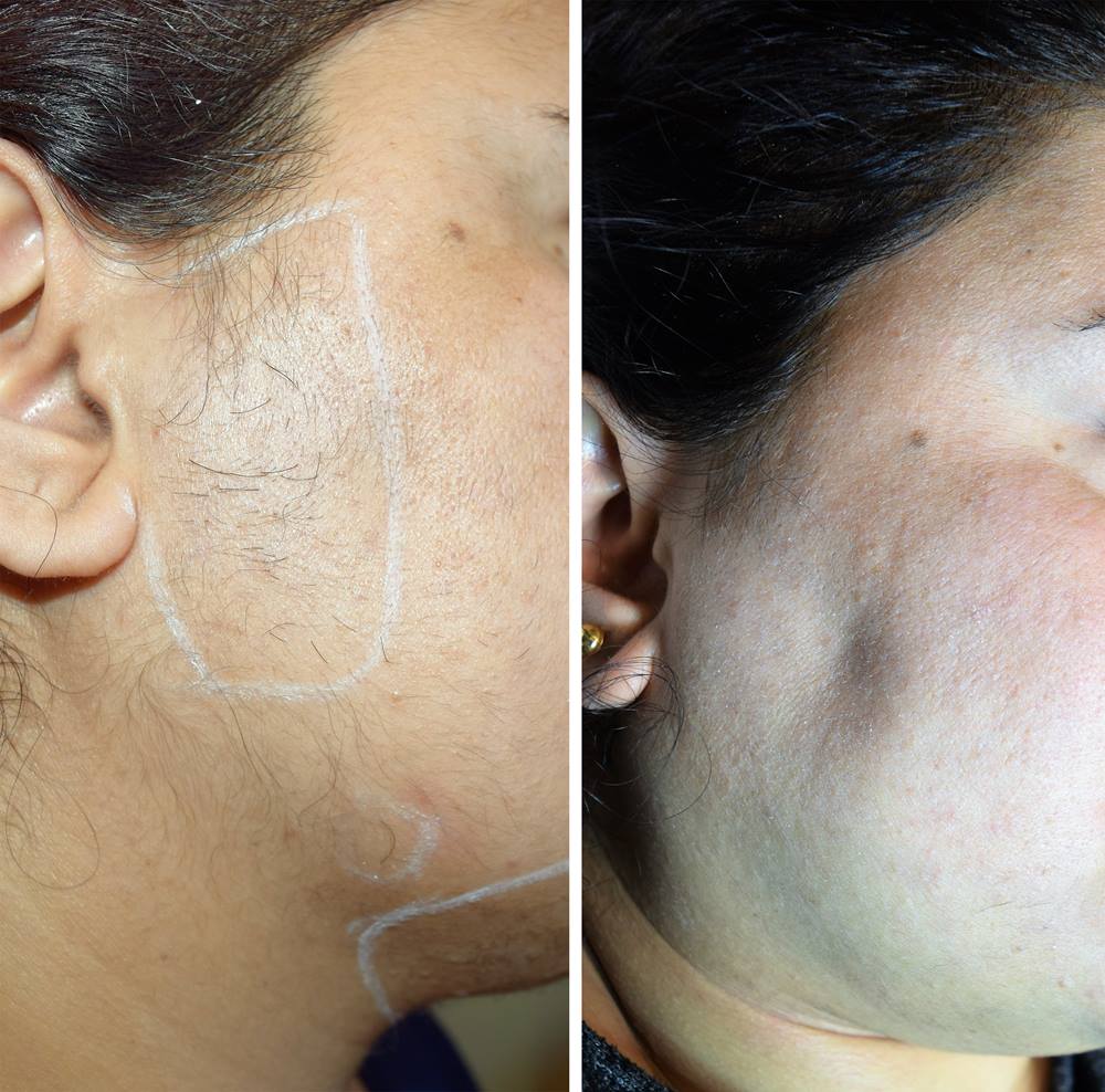 Laser Hair Removal Treatment & Service Allura Skin & Laser Centre