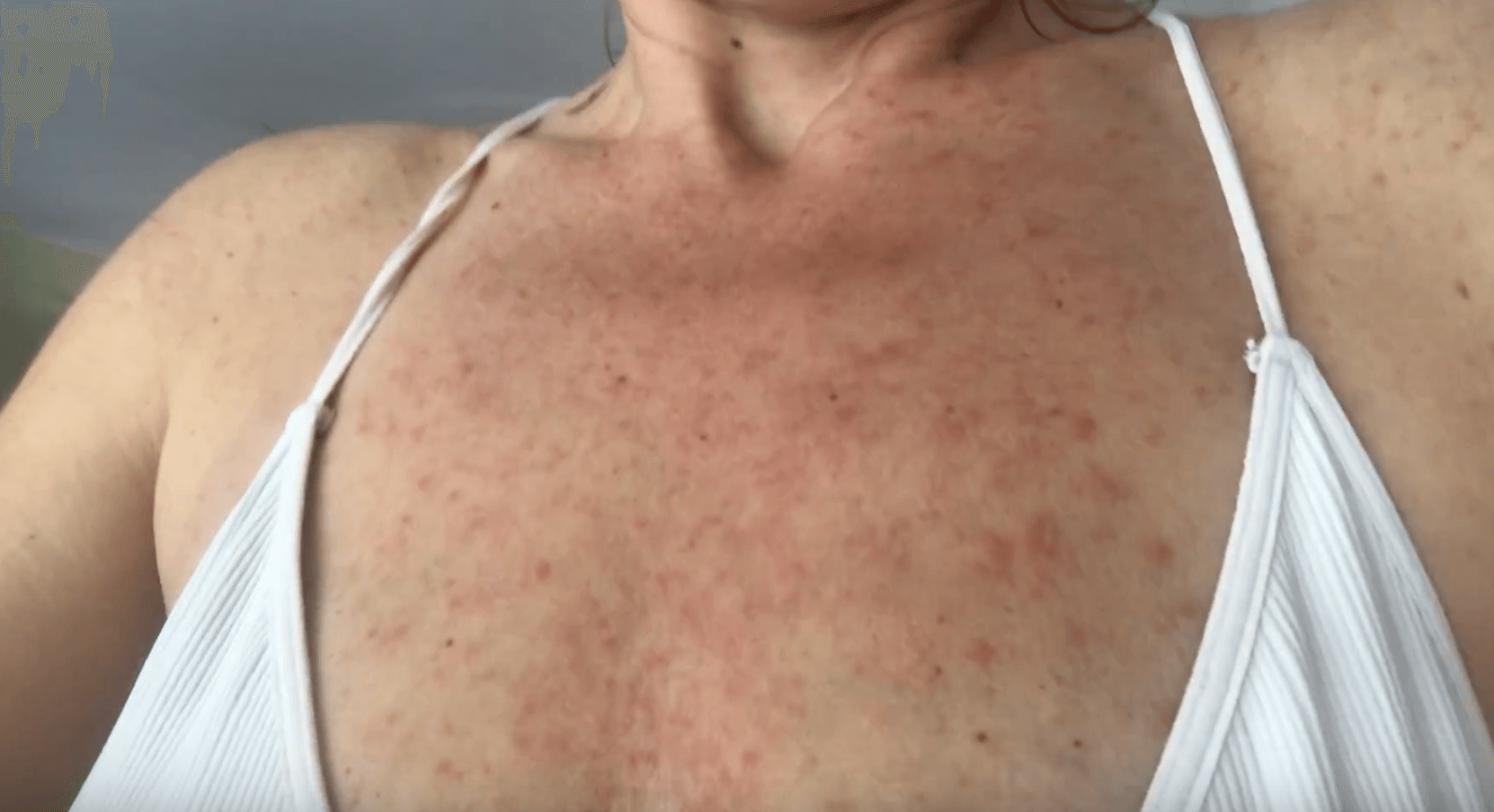 How to Cure PUPPP/PUPPS Pregnancy Rash Naturally Ally Boothroyd