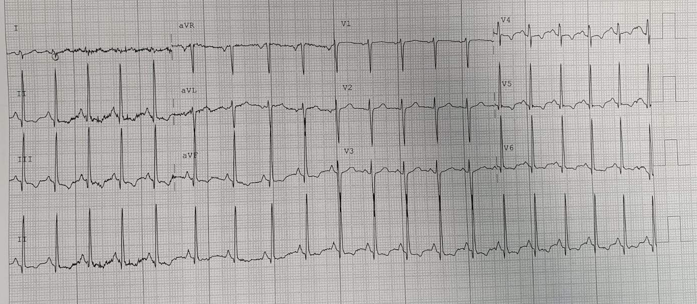 Pulmonary Embolism PE almostadoctor