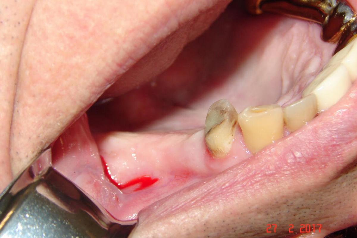 Alpha Dent Implants case report Placement of Active Bio implant in the