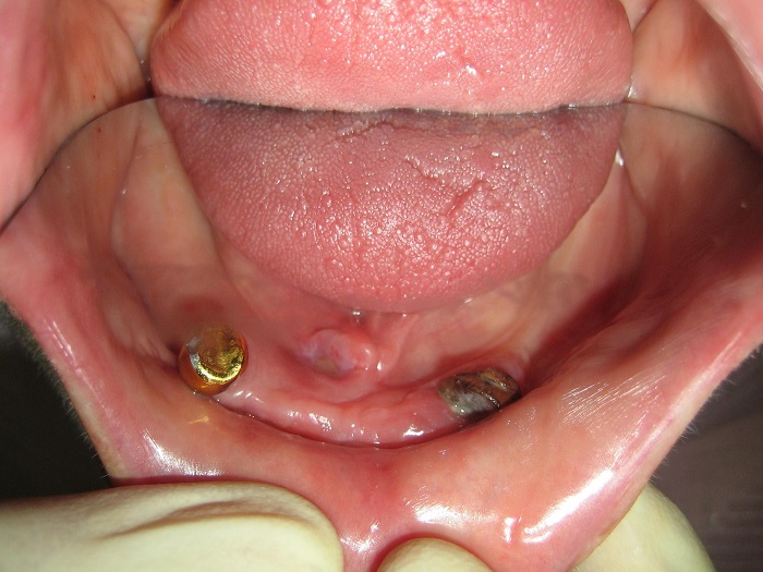 Placement of Alpha Dent Classic implants on the lower jaw Alpha Dent