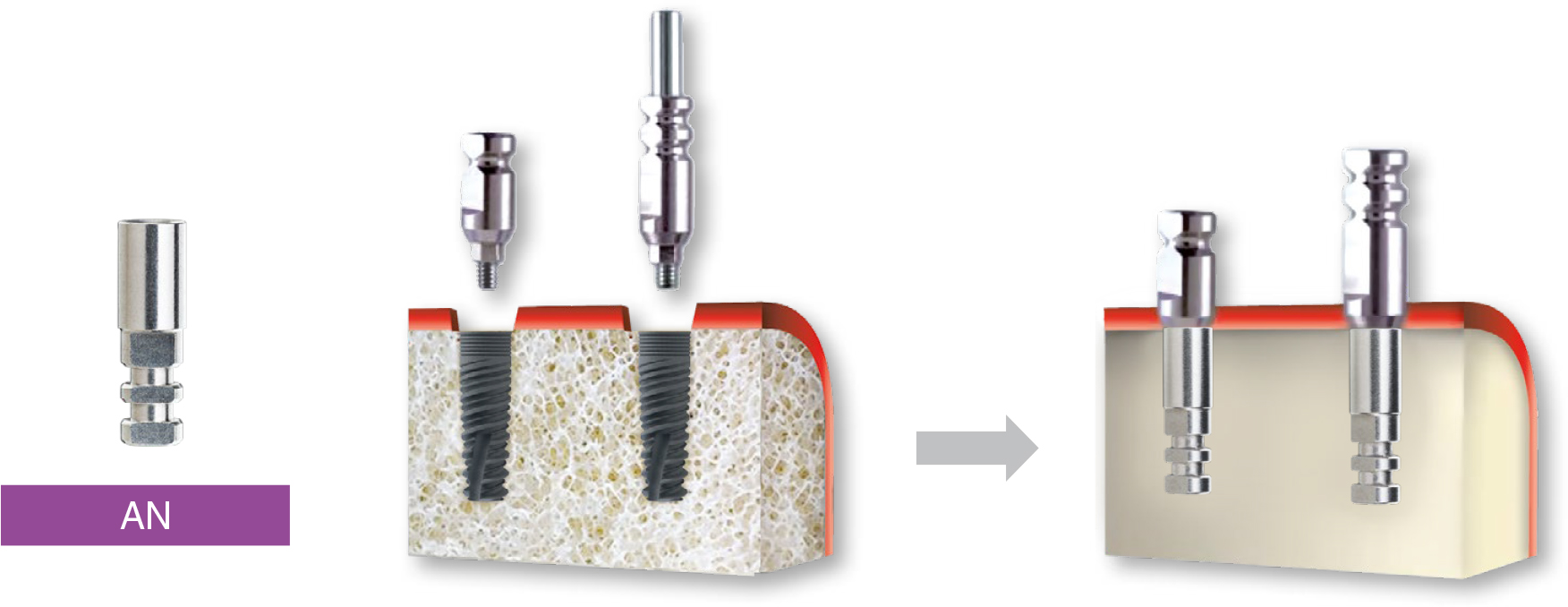 Implant Analog Alpha Dent Implants