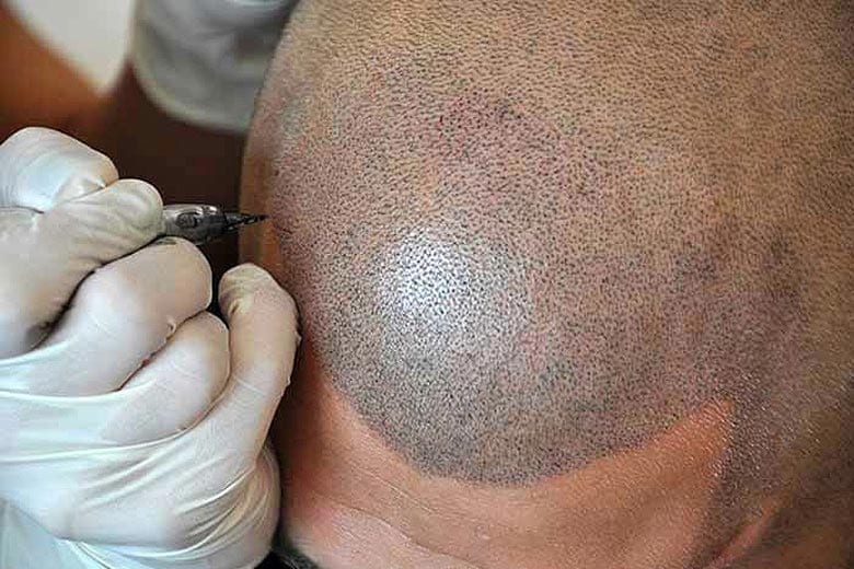 Hair Tattoo Treatment For Hair Loss in Las Vegas Nevada