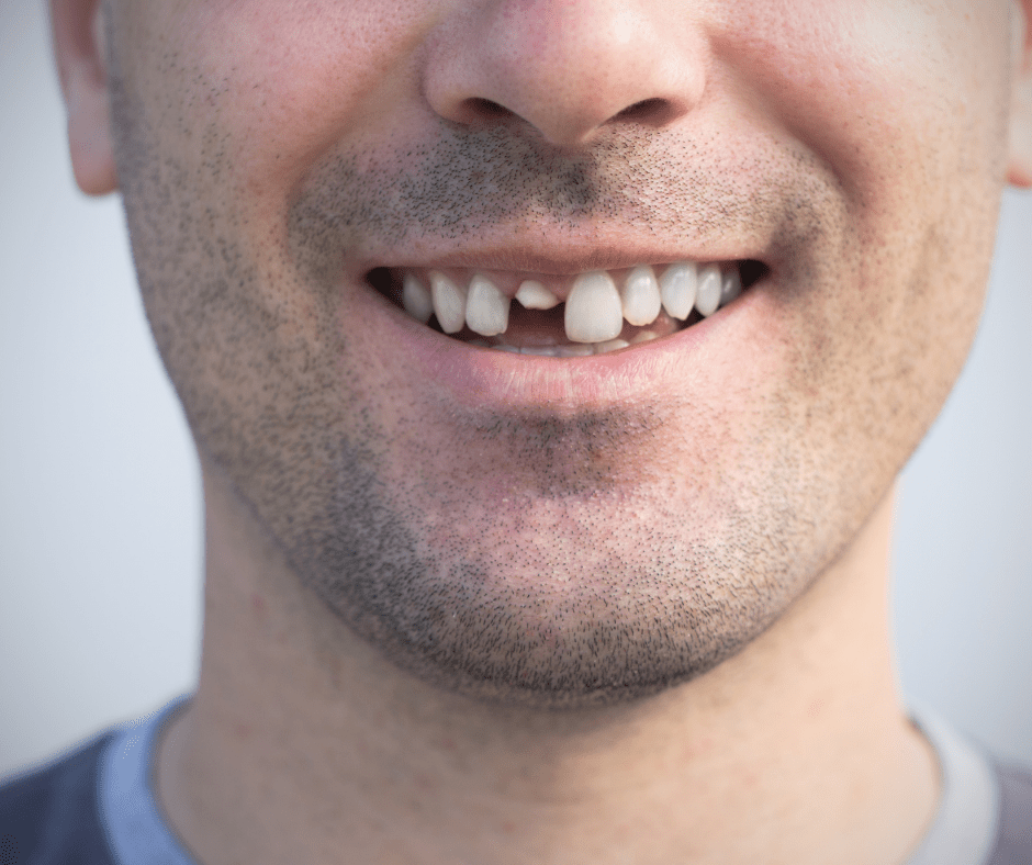 Dental Crowns in Alpine, UT Alpine Dentistry Dentist in Alpine, Utah