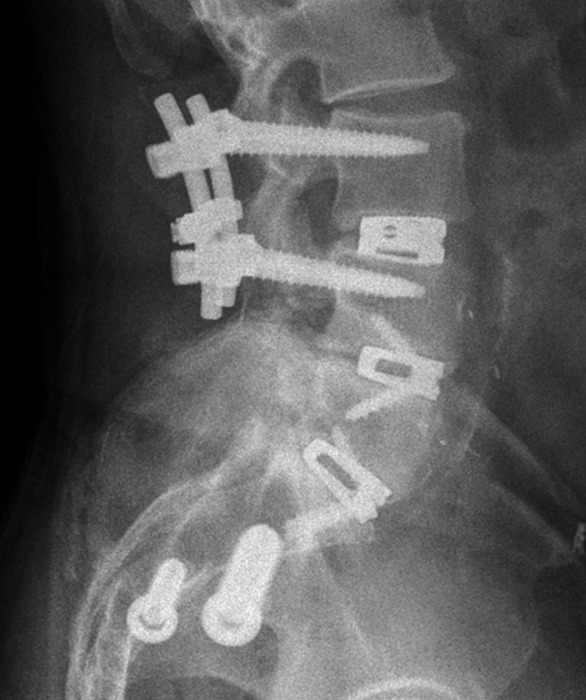 Spine Treatments Alpine Orthopaedic & Spine Spokane, WA