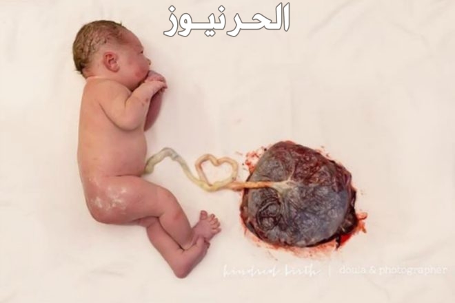 المشيمة الملتصقة