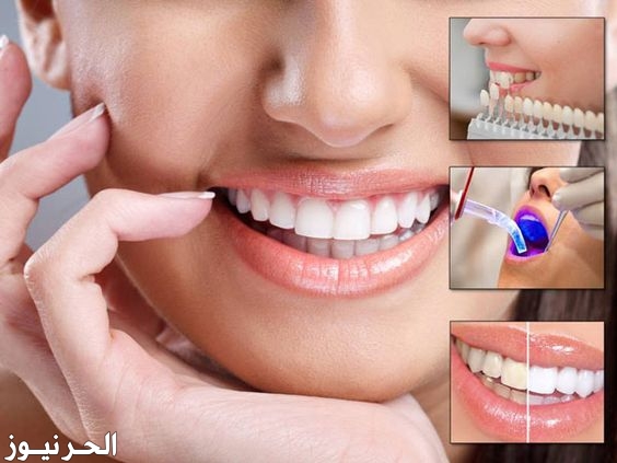 انواع تبييض الاسنان واسعارها