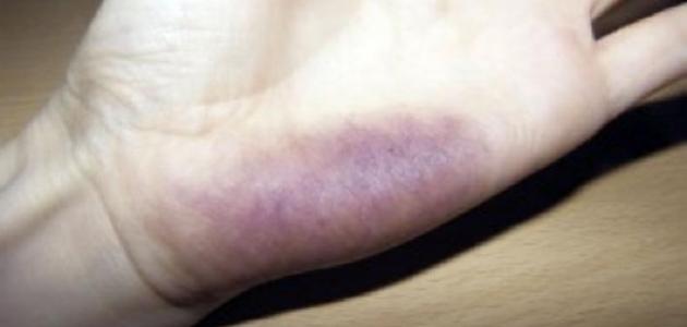 تفسير رؤية كدمات حمراء في المنام