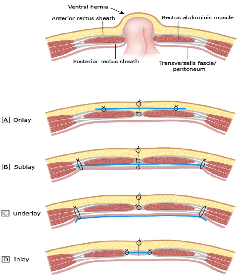 Incisional Hernia Repair