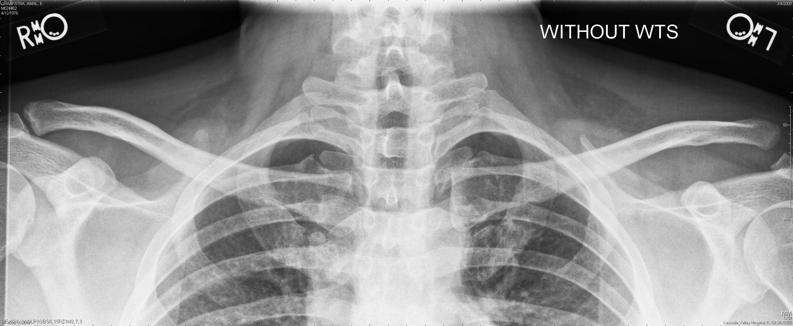 xray Amal Graafstra Technologist, Author & Double RFID Implantee