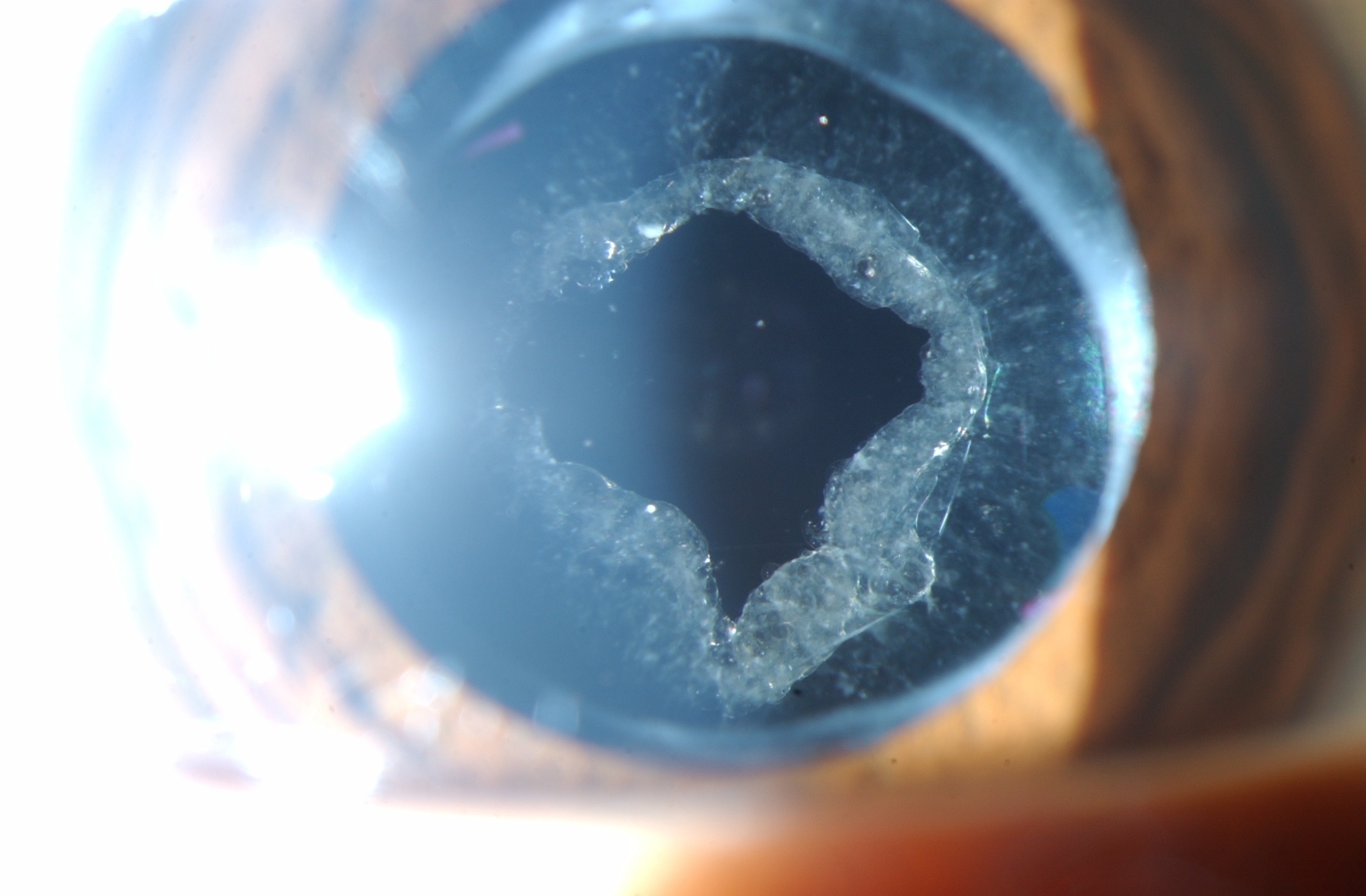 YAG Capsulotomy (YAG Laser Eye Surgery) Vitreous Retina, 44 OFF