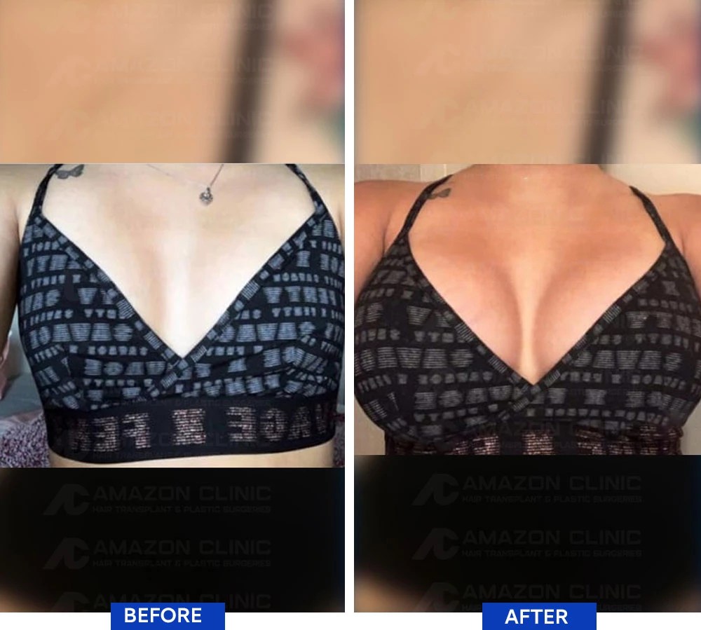 A Complete Guide to Breast Augmentation Surgery