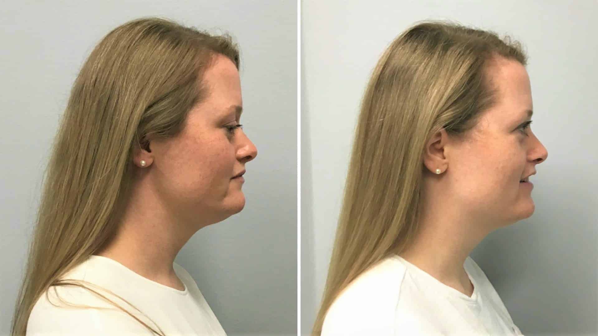 My Kybella Before and After How to Get Rid of Double Chin