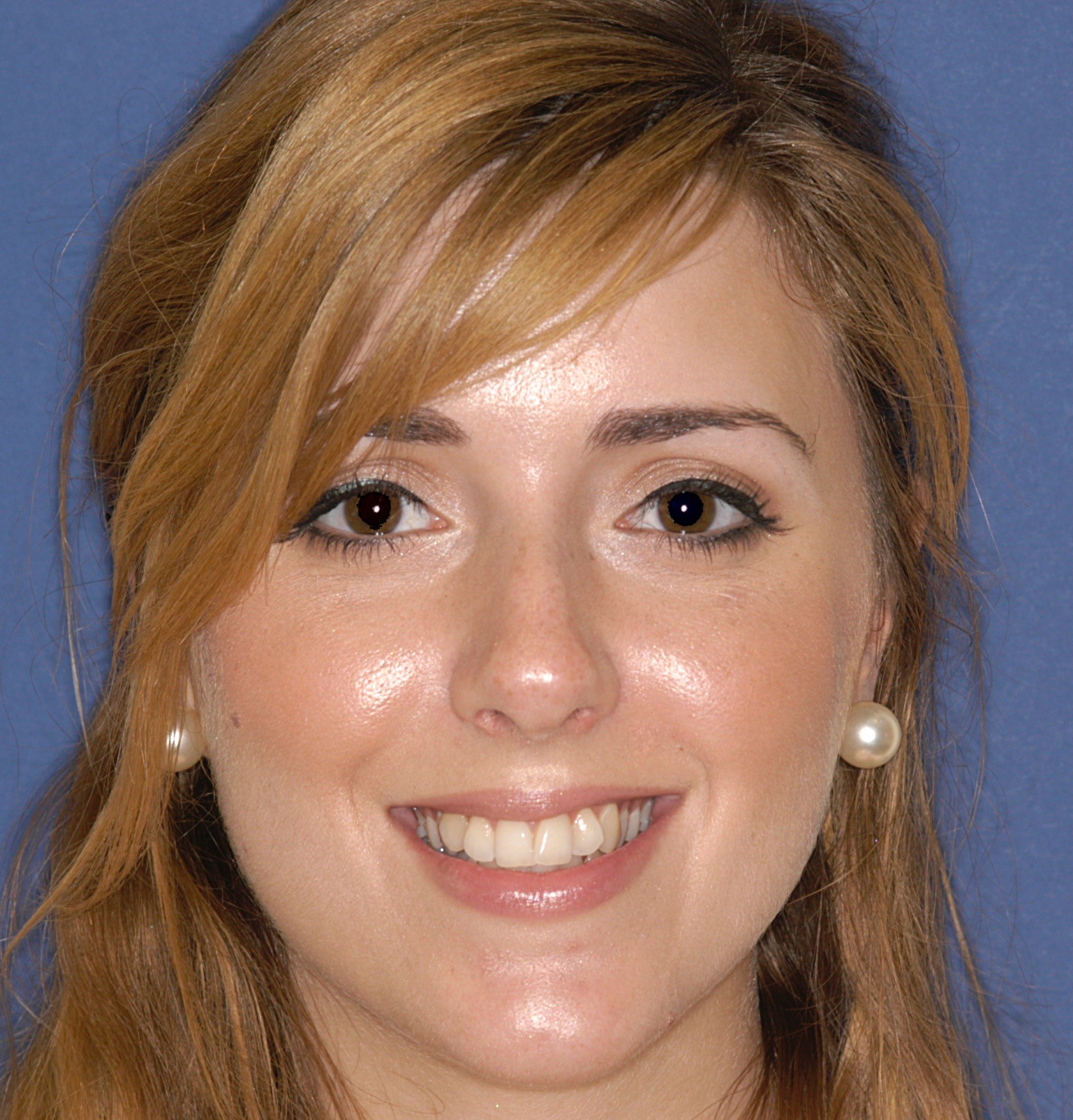 Dental veneers and Dental implants explained Ambridge Ceramics