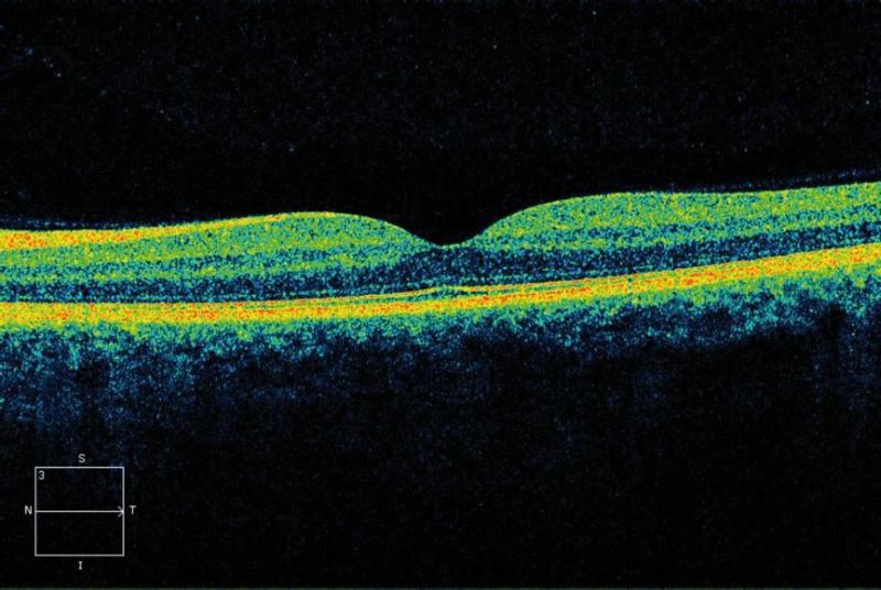 Optical Coherence Tomography in Agerelated Macular Degeneration www