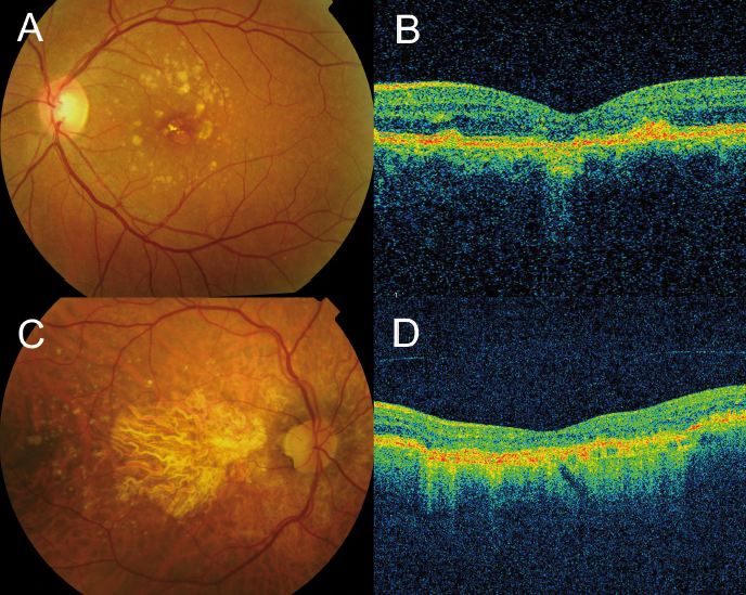 Optical Coherence Tomography in Agerelated Macular Degeneration www