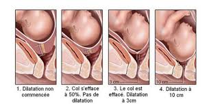 Comment faire pour augmenter le niveau de co2 bronchodilatateur ? Le Temps De La Poussee