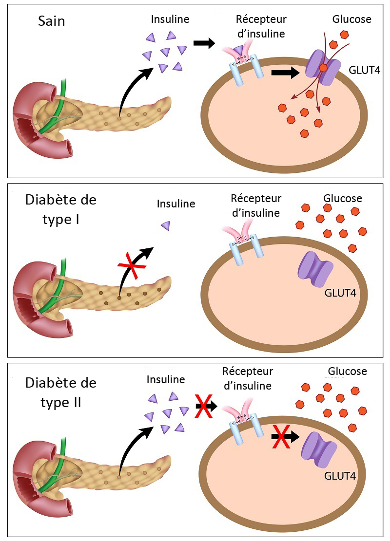 Comment reconnaître et traiter le diabète Améliore ta Santé