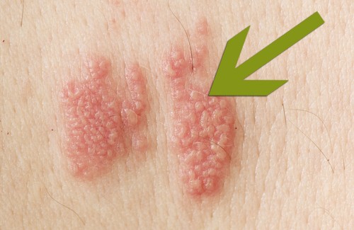 Comment avoir le zona