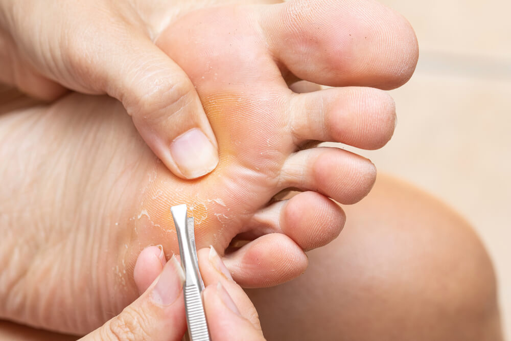 Cors aux pieds 7 remèdes maison Améliore ta Santé