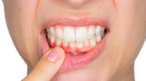 7 symptômes qui vous alertent d'une infection dentaire Améliore ta Santé