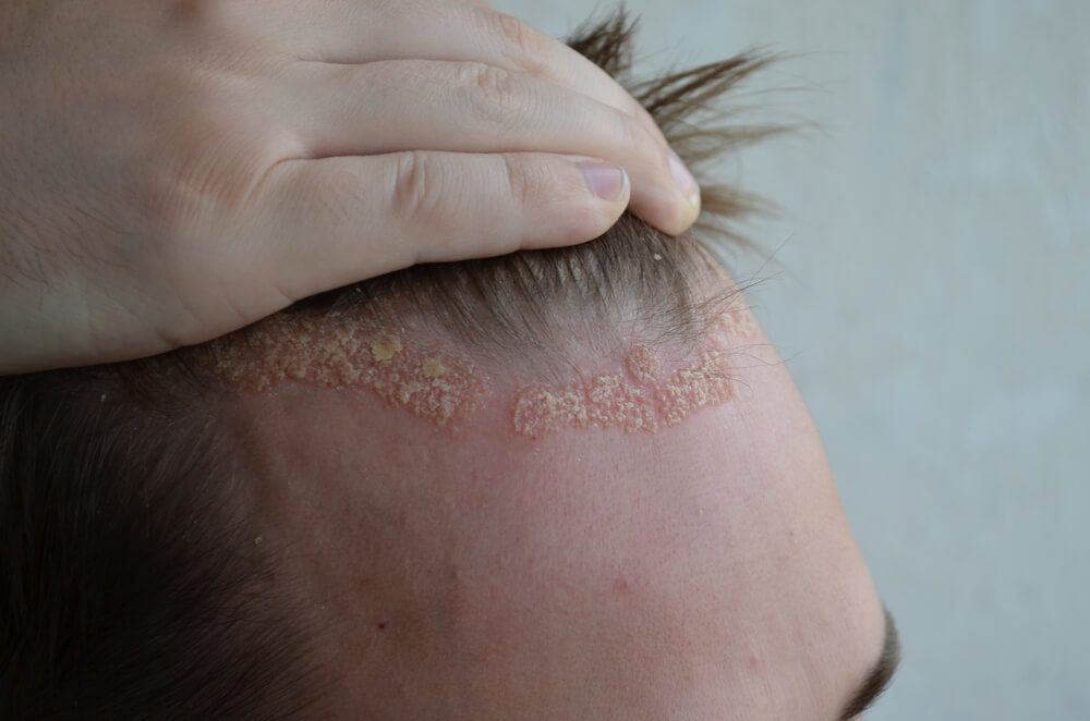 5 remèdes faits maison pour soulager le psoriasis du cuir chevelu