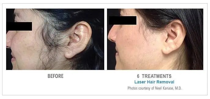 How Long Should I Stay out of the Sun After Laser Hair.
