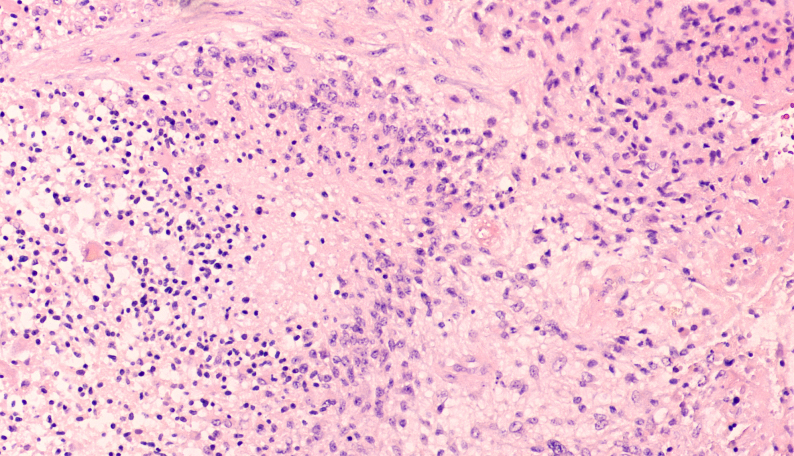 Microscopic image showing histology of a glioblastoma multiforme (GBM