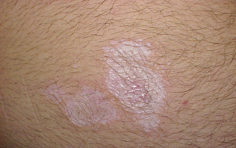 Case Study: Lichen Sclerosis - Amethyst Holistic Skin Solutions