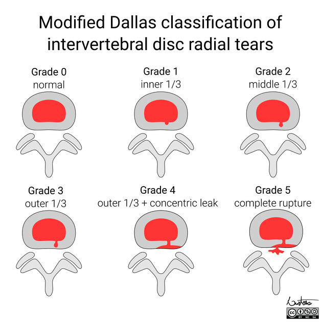 Annular Tear 7 Breakthrough Treatments for Lasting Relief