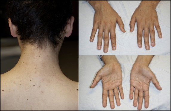 True, True, Related? Autoimmune Polyglandular Syndrome Type II The