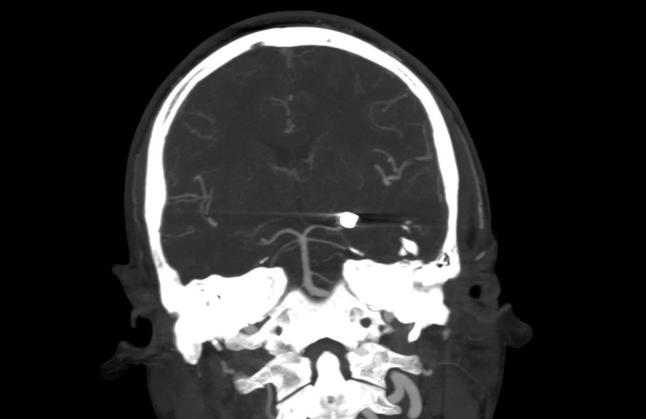 Gun pellet removed from 33 year old's brain by robotic neurosurgery