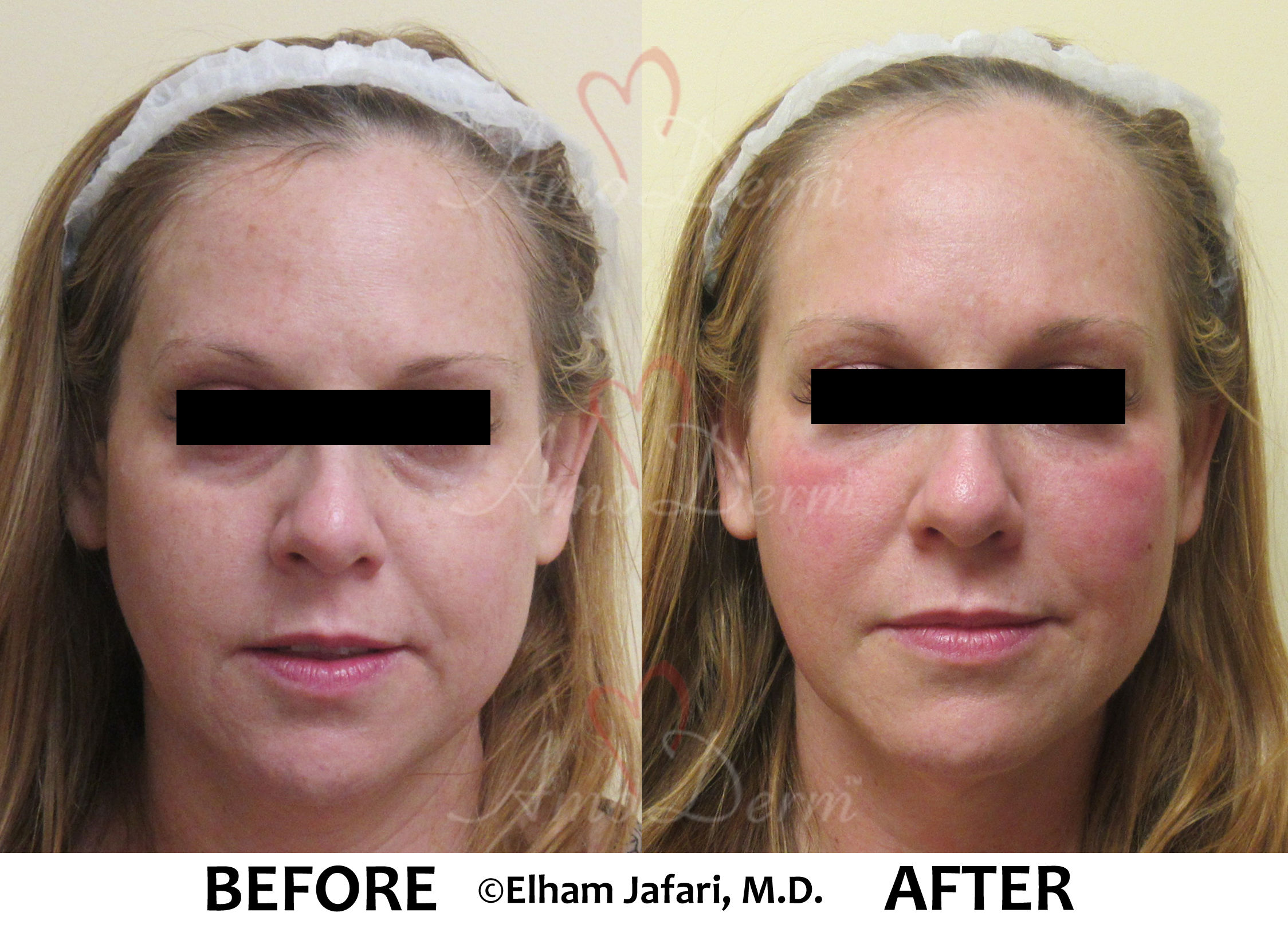 Treat dark circles & bags under eyes using fillers & lasers