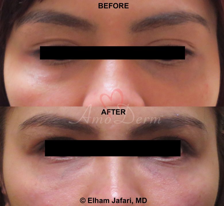 Treat dark circles & bags under eyes using fillers & lasers