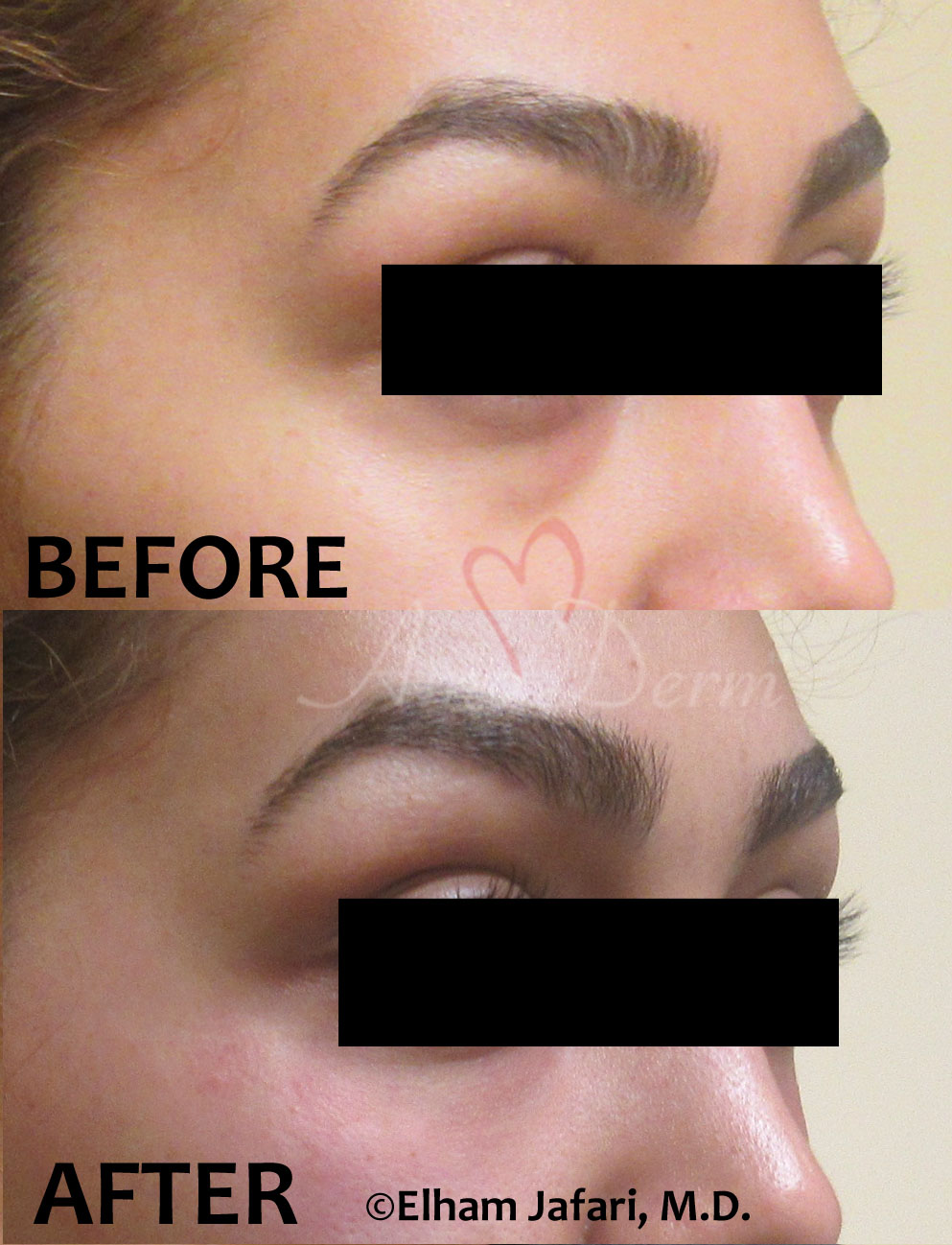 Treat dark circles & bags under eyes using fillers & lasers