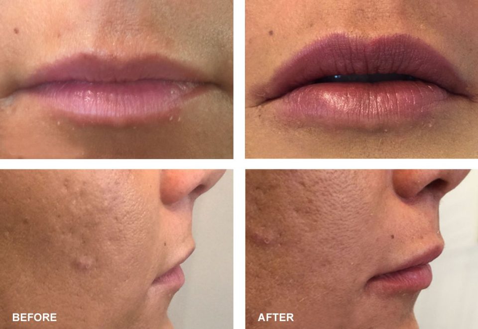 Thread Lift Nonsurgical Cosmetic Procedure in Irvine, Orange County
