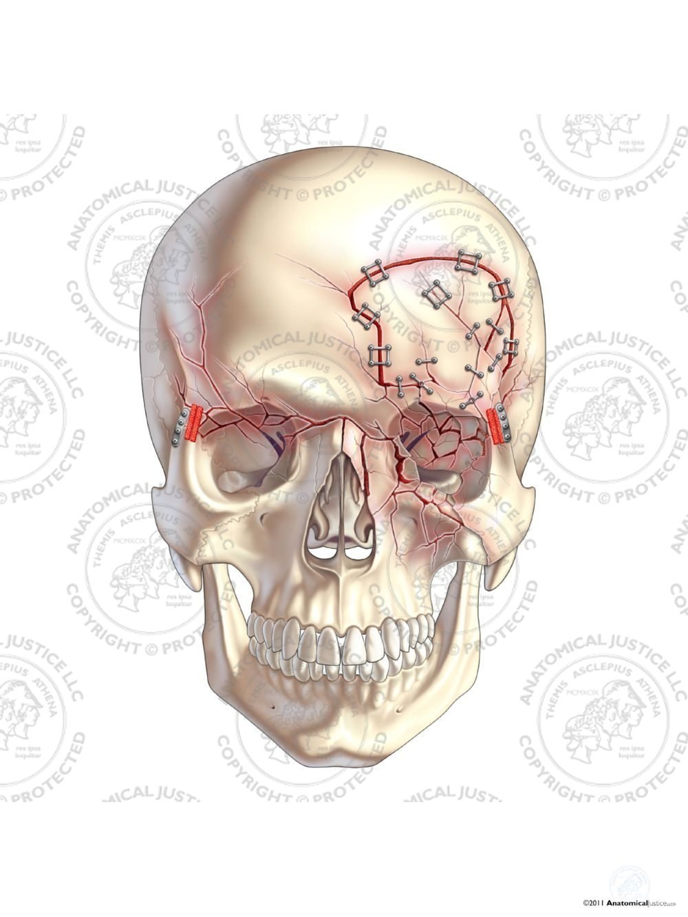 Left Craniotomy and Repair of Skull Fractures No Text