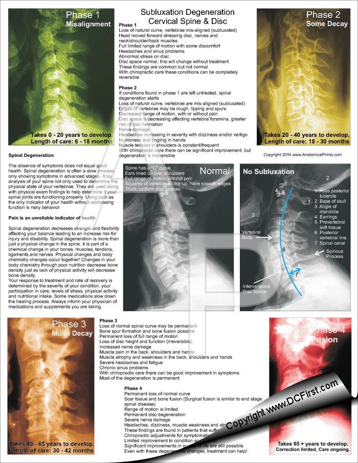 Stages of Subluxation Spinal Degeneration TearOff Sheets/Pad