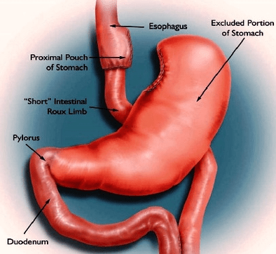 gastric bypass – Anatomy System – Human Body Anatomy diagram and chart
