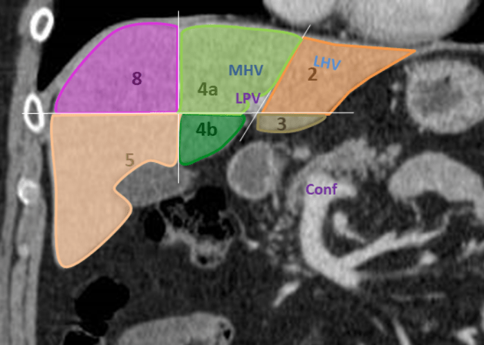 Radiopaedia CTscan Hepatic segments coronal section labels