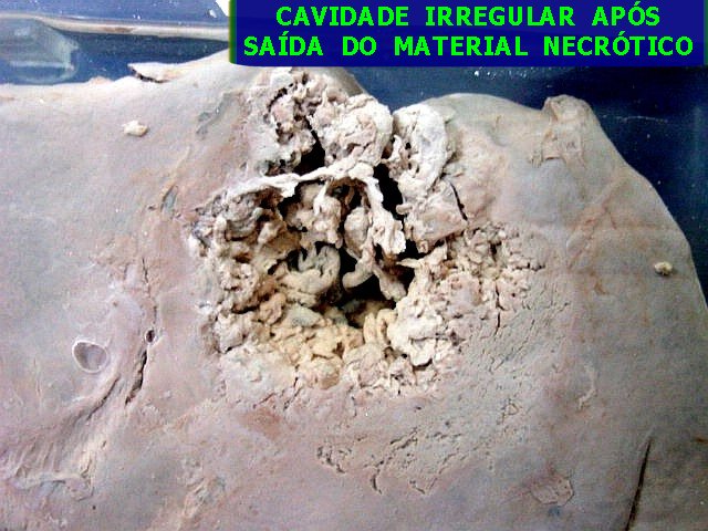 Abscessos amebianos no fígado.