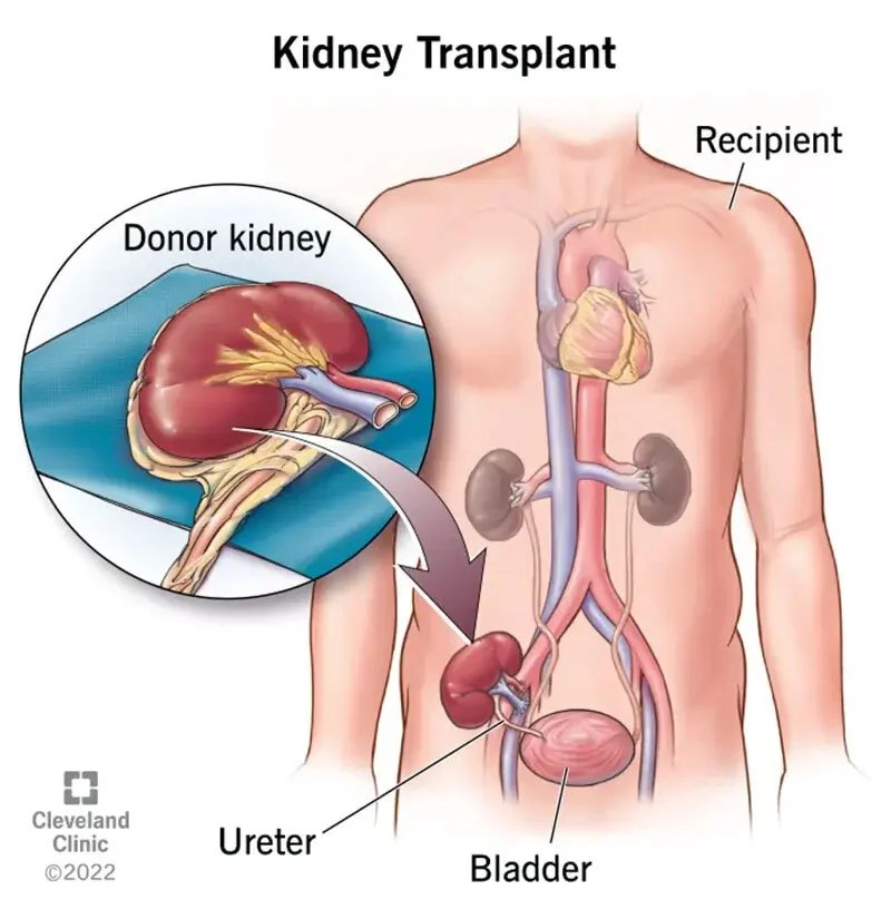 Life After Kidney Transplant What to Know Risks and Recovery