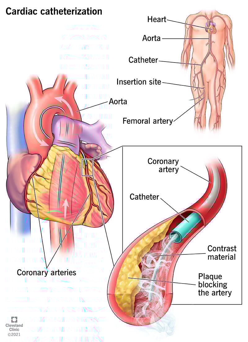 Cardiac Catheterization in Canada What to Expect and Reasons