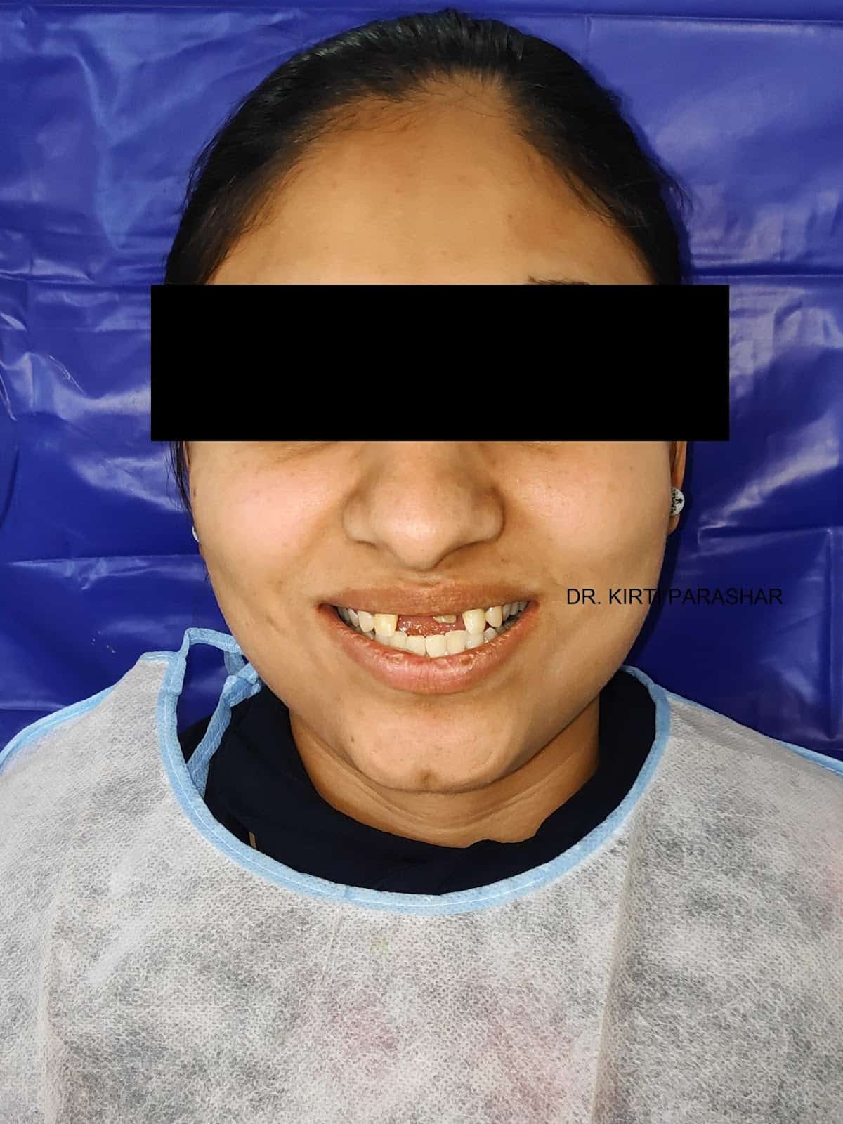 Before and After Temporary Dental Crown & Bridge Pictures Anaya Dental