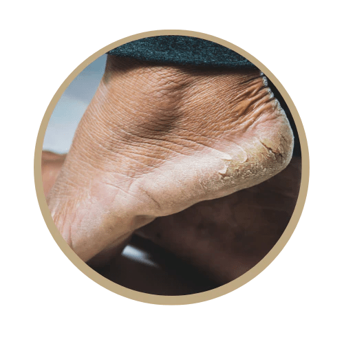Callus Care/Cracked Heel Ancaster Foot Fixer and Orthotics Clinic