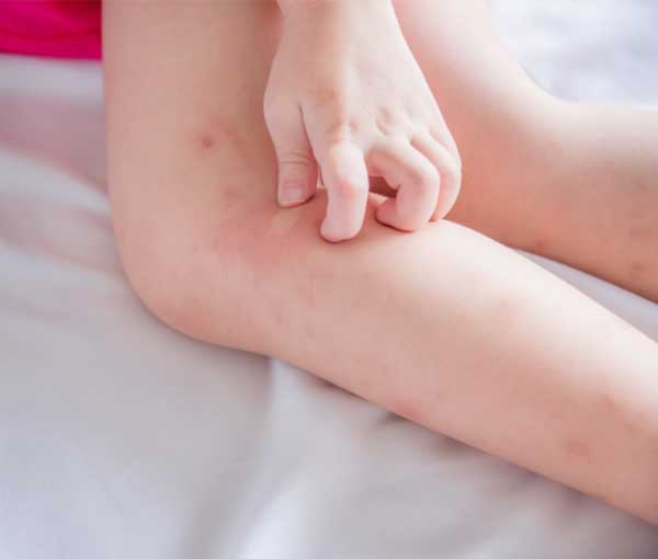 How to Treat Bed Bug Bites Bed Bug bites in Illinois & Indiana