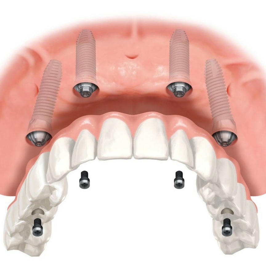 Dental Implants and Crowns Raleigh North Carolina